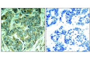 Immunohistochemical analysis of paraffin-embedded human breast carcinoma tissue, using p62Dok (phospho- Tyr398) antibody (E011277). (DOK1 anticorps  (pTyr398))