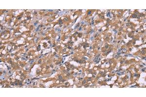 Immunohistochemistry of paraffin-embedded Human thyroid cancer using Histamine H3 Receptor Polyclonal Antibody at dilution of 1:50 (HRH3 anticorps)