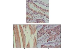 Immunohistochemical analysis of paraffin-embedded human lung cancer (A), muscles (B) and breast cancer (C) using MUSK antibody with DAB staining. (MUSK anticorps  (AA 24-209))