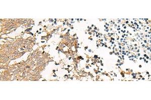 Immunohistochemistry of paraffin-embedded Human lung cancer tissue using GPR22 Polyclonal Antibody at dilution of 1:50(x200) (GPR22 anticorps)