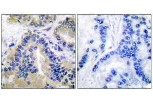 Immunohistochemical analysis of paraffin-embedded human lung carcinoma tissue, using Caspase 10 antibody. (Caspase 10 anticorps  (C-Term))