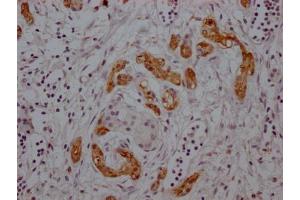 IHC image of ABIN7127620 diluted at 1:100 and staining in paraffin-embedded human pancreatic cancer performed on a Leica BondTM system. (Recombinant Midkine anticorps)