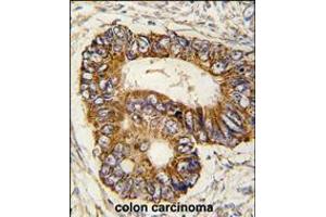 Formalin-fixed and paraffin-embedded human colon carcinoma tissue reacted with PHB2 Antibody (Y128) , which was peroxidase-conjugated to the secondary antibody, followed by DAB staining.
