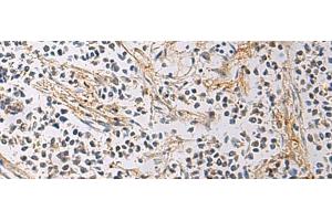 Immunohistochemistry of paraffin-embedded Human breast cancer tissue using GMPR Polyclonal Antibody at dilution of 1:60(x200) (GMPR anticorps)