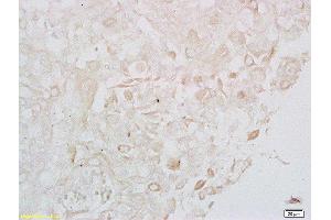 Formalin-fixed and paraffin embedded human cervical carcinoma labeled with Anti- LONP1 Polyclonal Antibody, Unconjugated  at 1:200 followed by conjugation to the secondary antibody (LONP1 anticorps  (AA 361-460))