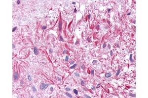 Anti-GIPR / GIP Receptor antibody IHC of human Brain, Glioblastoma.