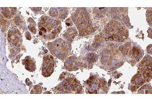 ABIN6277475 at 1/100 staining Human liver cancer tissue by IHC-P. (FSHR anticorps  (Internal Region))