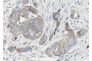 ABIN6267681 at 1/100 staining human Breast carcinoma tissue sections by IHC-P.