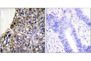 Immunohistochemistry analysis of paraffin-embedded human lung carcinoma tissue, using Claudin 7 Antibody. (Claudin 7 anticorps  (AA 162-211))