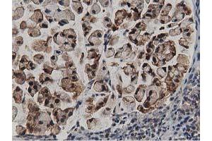 Immunohistochemical staining of paraffin-embedded Adenocarcinoma of Human colon tissue using anti-ACAT2 mouse monoclonal antibody. (ACAT2 anticorps)