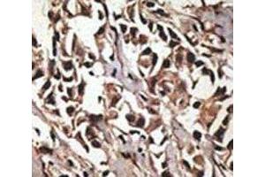 IHC analysis of FFPE human breast carcinoma tissue stained with the PRMT7 antibody (PRMT7 anticorps  (AA 660-692))