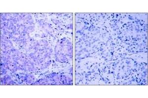 Immunohistochemistry analysis of paraffin-embedded human breast carcinoma, using PDK1 (Phospho-Ser241) Antibody.