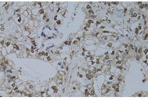 Immunohistochemistry of paraffin-embedded Human gastric cancer using HUS1 Polyclonal Antibody at dilution of 1:100 (40x lens).