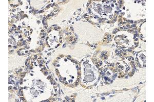 ABIN6257851 and ABIN6275627 at 1/100 staining human ovarian cancer by IHC-P. (TSSK4 anticorps  (Internal Region))