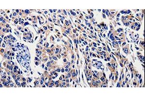 Immunohistochemistry of paraffin-embedded Human lung cancer tissue using IL10RB Polyclonal Antibody at dilution 1:60 (IL10RB anticorps)