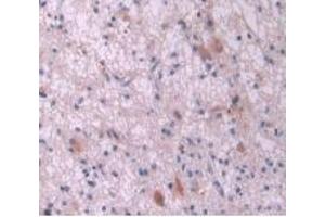 IHC-P analysis of Human Glioma Tissue, with DAB staining. (IL-2 anticorps  (AA 21-153))