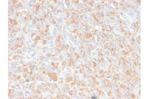 Formalin-fixed, paraffin-embedded human Histiocytoma stained with TNF alpha Mouse Monoclonal Antibody (4C6-H8). (TNF alpha anticorps  (AA 115-130))