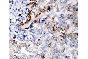 IHC-P: LAMC2 antibody testing of human lung cancer tissue (LAMC2 anticorps  (C-Term))