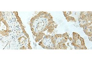 Immunohistochemistry of paraffin-embedded Human thyroid cancer tissue using ETAA1 Polyclonal Antibody at dilution of 1:25(x200) (ETAA1 anticorps)