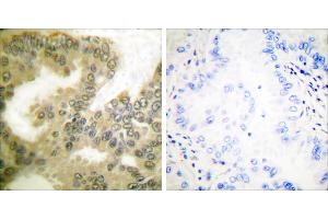 P-peptide - +Immunohistochemical analysis of paraffin-embedded human lung carcinoma tissue using Cyclin D3 (Phospho-Thr283) Antibody (#A0418).