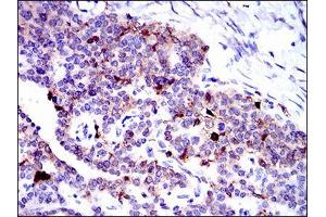 Immunohistochemical analysis of paraffin-embedded ovarian cancer tissues using ANXA1 mouse mAb with DAB staining.
