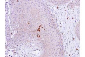 IHC-P Image Immunohistochemical analysis of paraffin-embedded Cal27 xenograft, using PAD4, antibody at 1:100 dilution.