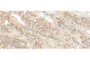Immunohistochemistry of paraffin-embedded Human gastric cancer tissue using EXOSC9 Polyclonal Antibody at dilution of 1:35(x200) (EXOSC9 anticorps)