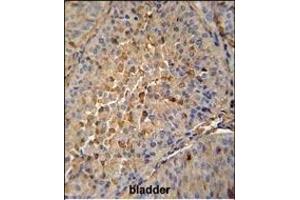 PRE1 antibody (N-term) (ABIN652240 and ABIN2841004) immunohistochemistry analysis in forlin fixed and paraffin embedded hun bladder carcino followed by peroxidase conjugation of the secondary antibody and DAB staining. (MAPRE1 anticorps  (N-Term))