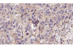 ABIN6273000 at 1/100 staining Human Melanoma tissue by IHC-P. (Glutathione Peroxidase 7 anticorps  (Internal Region))