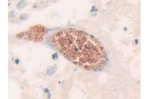 Detection of BND3 in Human Breast cancer Tissue using Polyclonal Antibody to Band 3 (BND3)