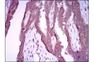 Immunohistochemical analysis of paraffin-embedded breast cancer tissues using NOS2 mouse mAb with DAB staining.