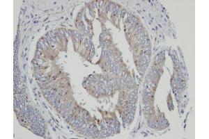 IHC-P Image Immunohistochemical analysis of paraffin-embedded human mixed ovarian cancer, using CYP4A11, antibody at 1:100 dilution. (CYP4A11 anticorps  (Center))