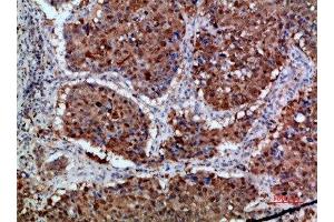 Immunohistochemical analysis of paraffin-embedded human-lung-cancer, antibody was diluted at 1:200 (Integrin alpha 1 anticorps  (AA 920-980))