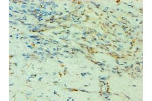 Immunohistochemistry of paraffin-embedded human breast cancer using ABIN7155523 at dilution of 1:100
