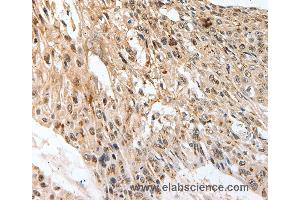 Immunohistochemistry of Human esophagus cancer using SLC1A7 Polyclonal Antibody at dilution of 1:60 (SLC1A7 anticorps)