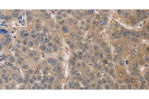 Immunohistochemistry of paraffin-embedded Human liver cancer using DPYSL3 Polyclonal Antibody at dilution of 1:30 (DPYSL3 anticorps)
