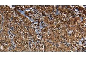 Immunohistochemistry of paraffin-embedded Human thyroid cancer using GLO1 Polyclonal Antibody at dilution of 1:50 (GLO1 anticorps)