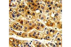 IHC analysis of FFPE human hepatocarcinoma with IkB alpha antibody