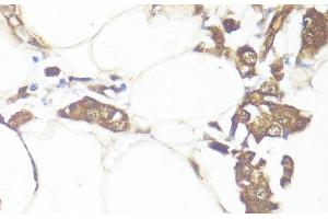 Immunohistochemistry of paraffin-embedded Human breast cancer using SMAD7 Polyclonal Antibody at dilution of 1:100 (40x lens). (SMAD7 anticorps)