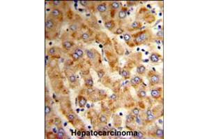 Formalin-fixed and paraffin-embedded human hepatocarcinoma reacted with HYOU1 Antibody , which was peroxidase-conjugated to the secondary antibody, followed by DAB staining.