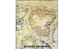FAM105B Antibody immunohistochemistry analysis in formalin fixed and paraffin embedded human prostate carcinoma followed by peroxidase conjugation of the secondary antibody and DAB staining. (FAM105B anticorps  (AA 99-128))