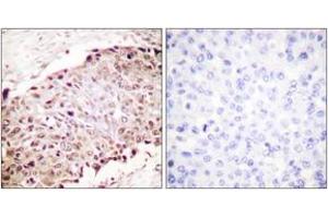 Immunohistochemistry analysis of paraffin-embedded human breast carcinoma tissue, using Sumo1 Antibody.