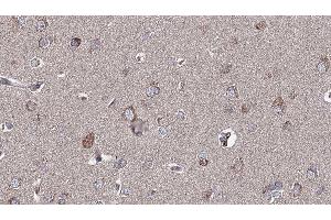 ABIN6276904 at 1/100 staining Human brain cancer tissue by IHC-P. (Glutamate Receptor 1 anticorps  (C-Term))