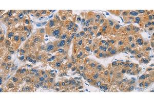 Immunohistochemistry of paraffin-embedded Human liver cancer tissue using CERK Polyclonal Antibody at dilution 1:30 (CERK anticorps)