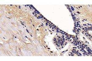 Detection of RIPK1 in Human Mammary gland Tissue using Polyclonal Antibody to Receptor Interacting Serine Threonine Kinase 1 (RIPK1) (RIPK1 anticorps  (AA 17-289))