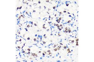 Immunohistochemistry of paraffin-embedded Human liver cancer using MYEF2 Rabbit pAb (ABIN7268721) at dilution of 1:100 (40x lens). (MYEF2 anticorps  (AA 1-120))