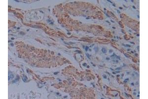 Detection of PLS3 in Human Stomach cancer Tissue using Polyclonal Antibody to Plastin 3 (PLS3)