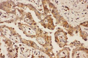 Anti-CXCR3 Picoband antibody,  IHC(P): Human Lung Cancer Tissue (CXCR3 anticorps  (AA 1-368))