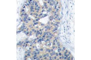 Immunohistochemistry of paraffin-embedded human breast carcinoma using Phospho-STMN1-S38 antibody (ABIN2987644). (Stathmin 1 anticorps  (pSer38))
