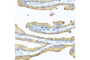 Immunohistochemistry of paraffin-embedded human prostate using TAC1 antibody at dilution of 1:100 (40x lens). (TAC1 anticorps)